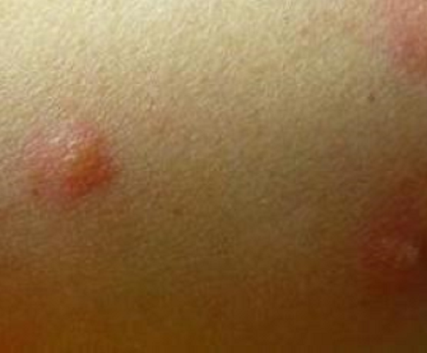 丘疹性荨麻疹症状水痘形成