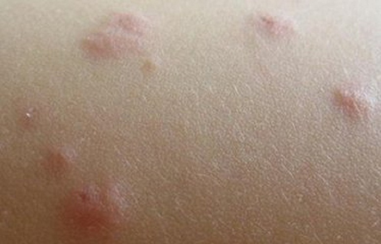 初期丘疹性荨麻疹状图片