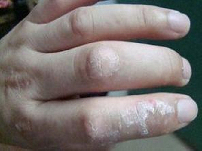 真菌性皮肤病手指手部
