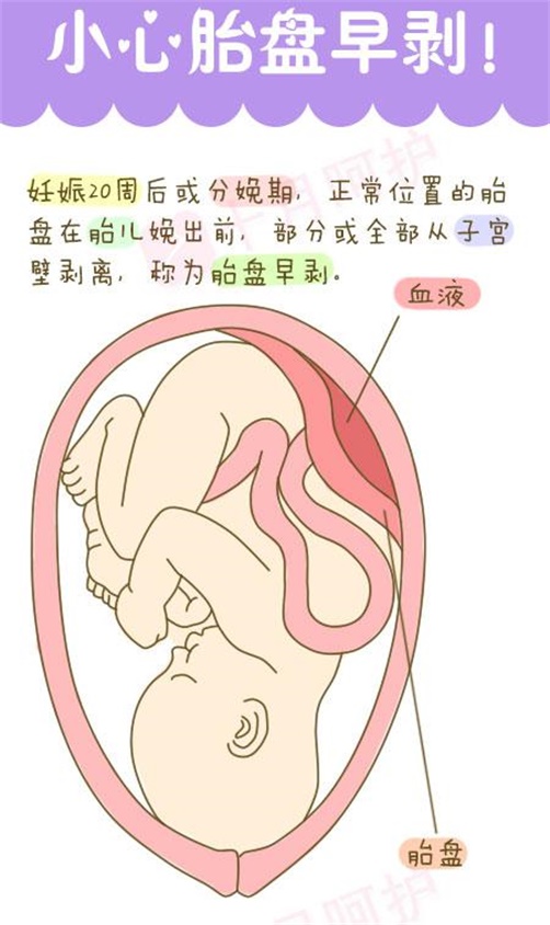 胎盘早剥