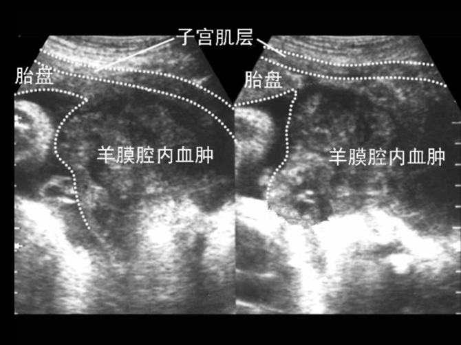 胎盘早剥血肿超声图片