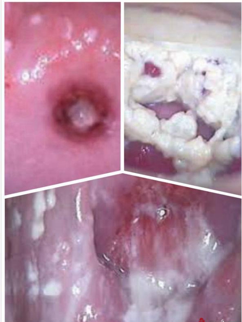 白带像豆腐渣外阴瘙痒图片