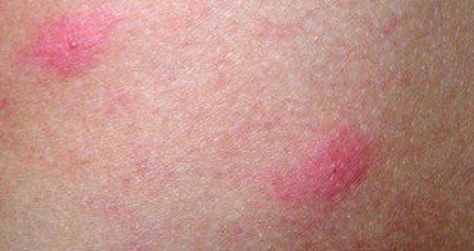 丘疹性荨麻疹症状及图片