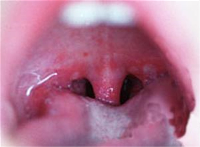 口腔单纯性疱疹症状图片