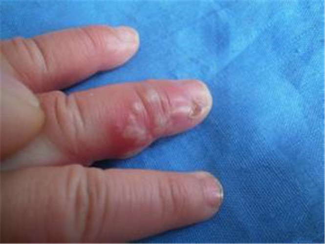 儿童手指单纯性疱疹重度症状图片