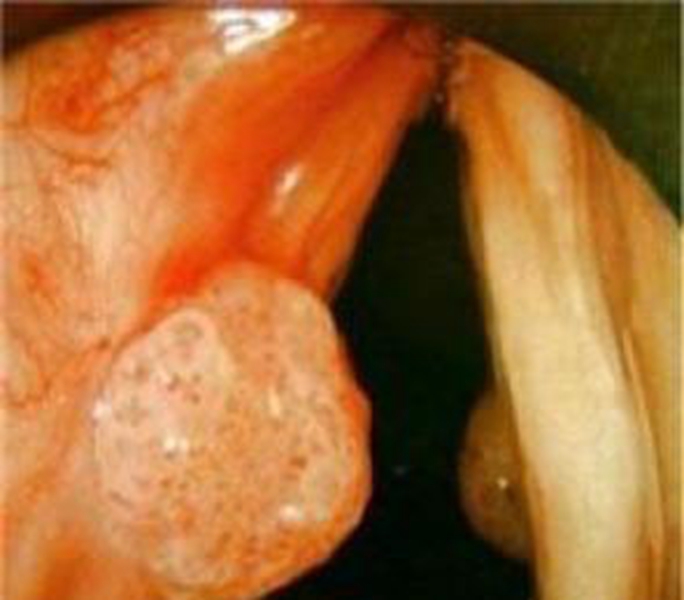 未患喉血管瘤的图片