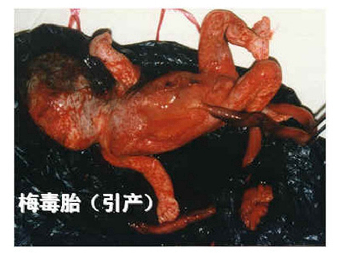 早期妊娠合并梅毒图片