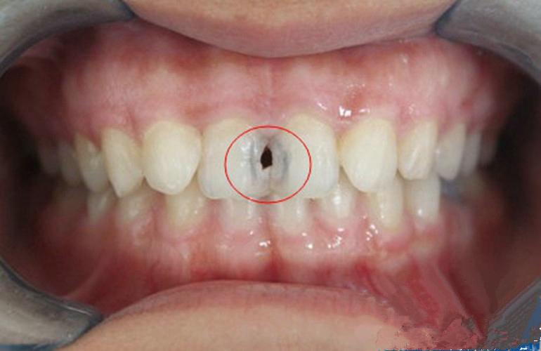 门牙龋齿图片