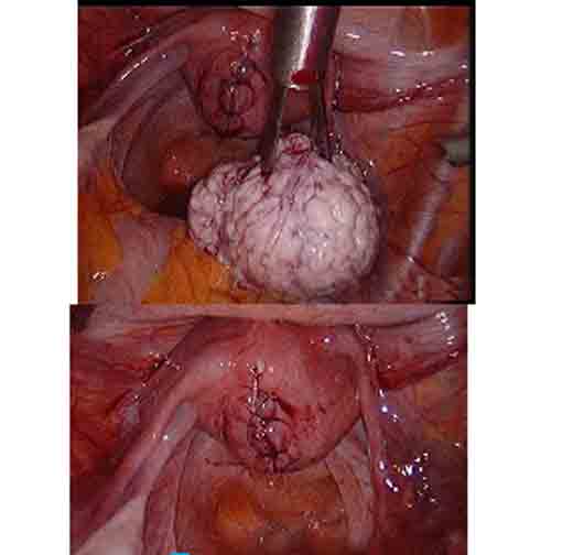 子宫粘膜下子宫肌瘤图片