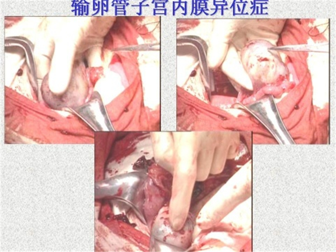 输卵管宫外孕手术图片