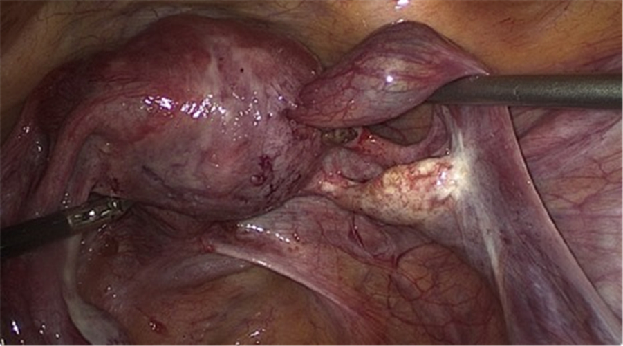 输卵管嵌顿宫外孕图片