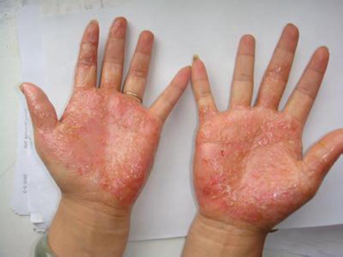 手部湿疹治疗后的图片