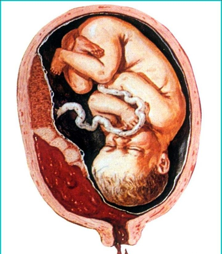 胎盘早期剥离图片