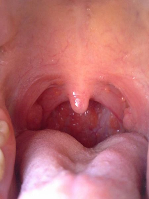 喉咙扁桃体肿大图片