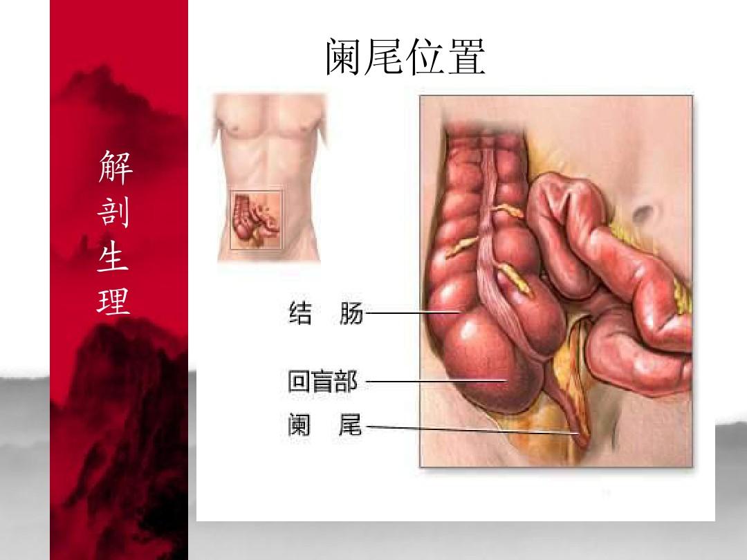 阑尾炎图片位置示意图