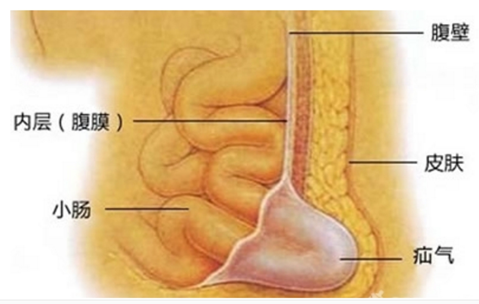 小儿疝气