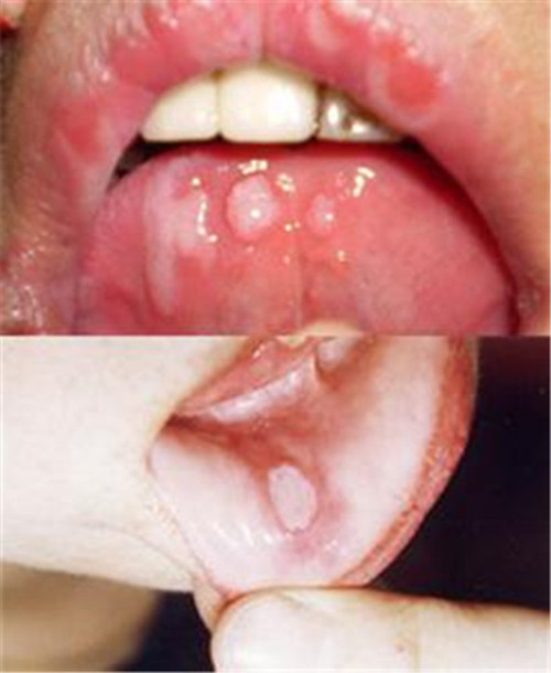 舌头单纯性疱疹中度症状图片