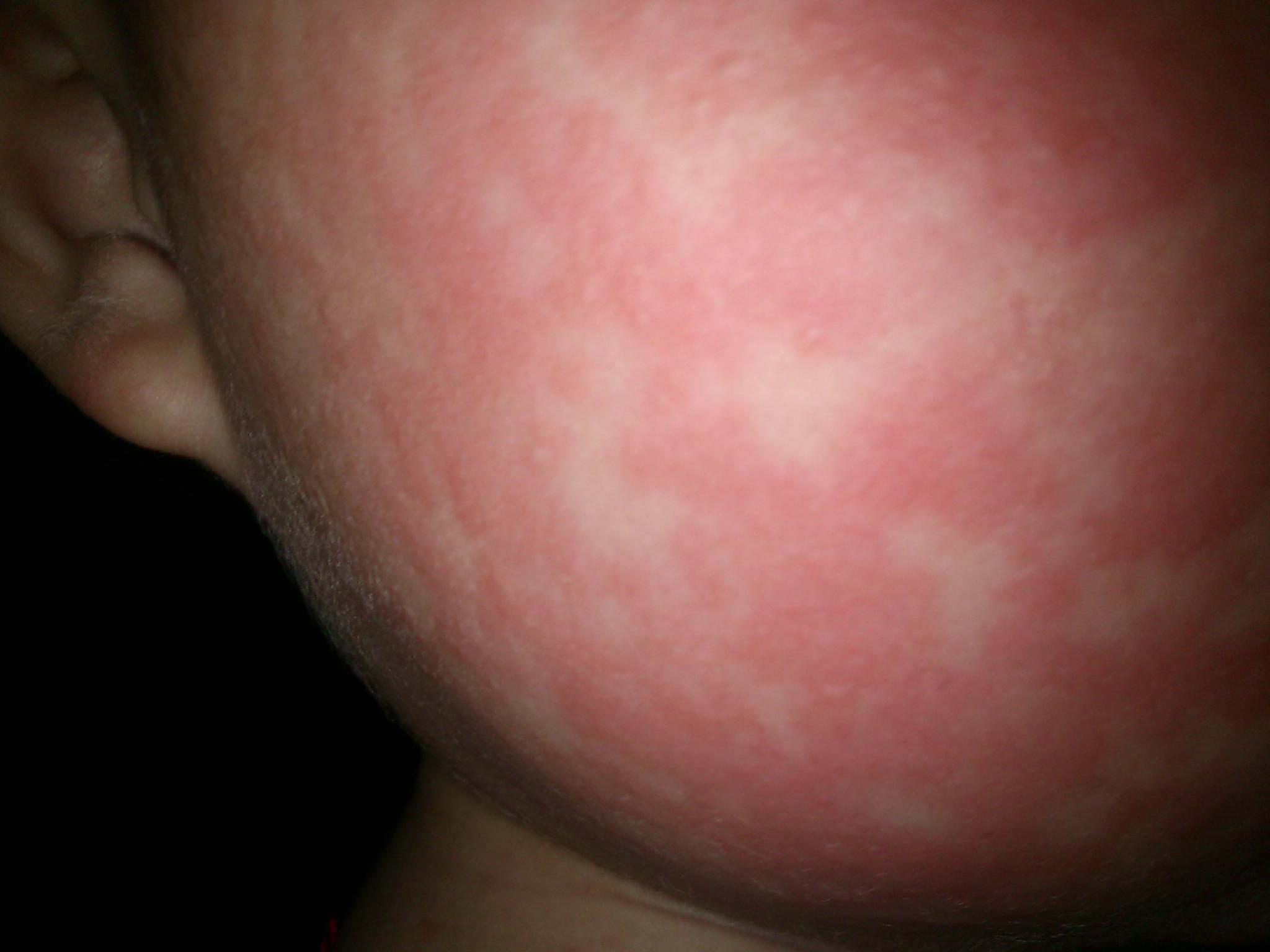 春季，荨麻疹高发季节，中药外洗帮孩子预防、克服荨麻疹 - 知乎