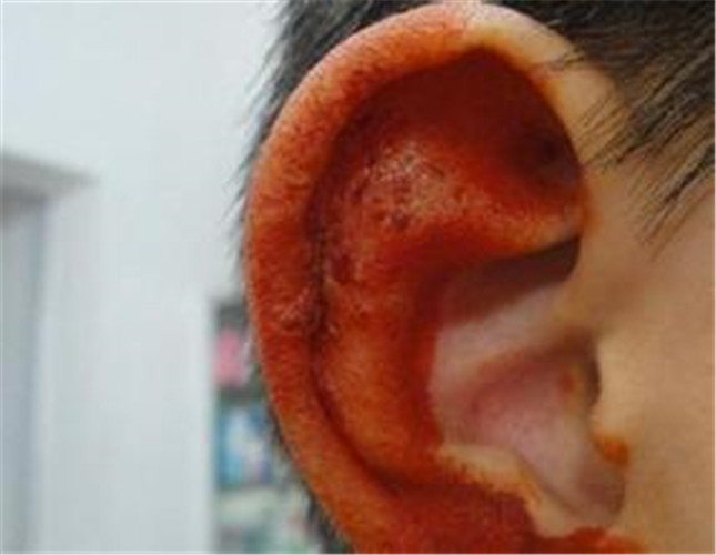 儿童耳部单纯性疱疹重度症状图片