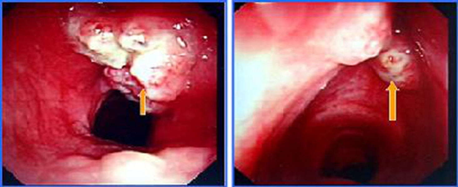 晚期喉血管瘤诊治图片