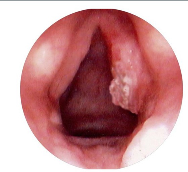 清晰喉血管瘤图片
