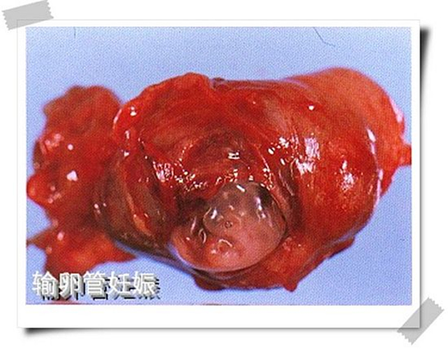 输卵管宫外孕图片