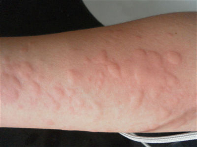 寒冷性荨麻疹手背皮肤病图片