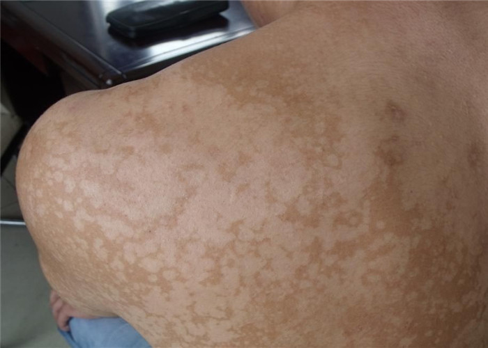 花斑癣成年女性背部皮肤症状图片