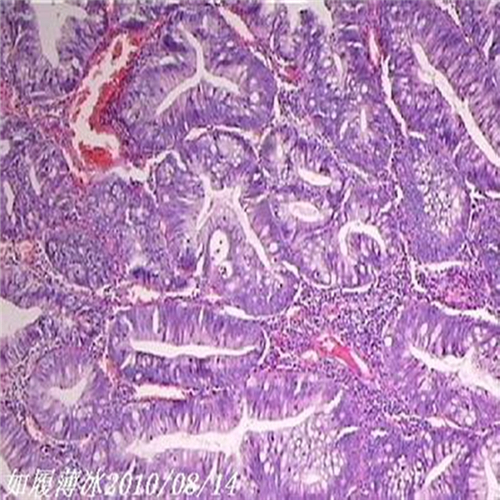 直肠息肉细胞图片
