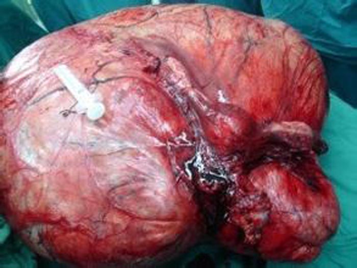 子宫肌瘤真实图片