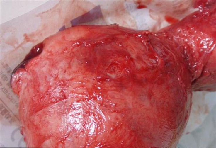 子宫颈巨大的子宫肌瘤图片