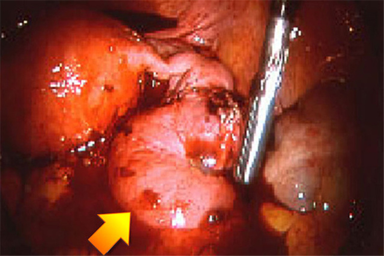输卵管壶腹部宫外孕图片