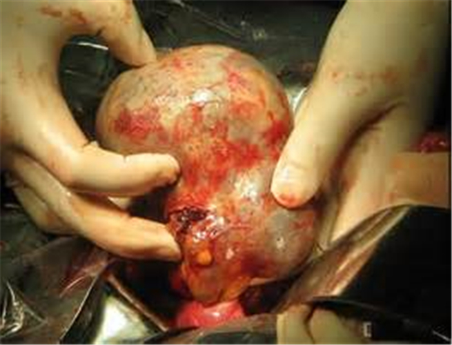 摘除宫外孕手术图片