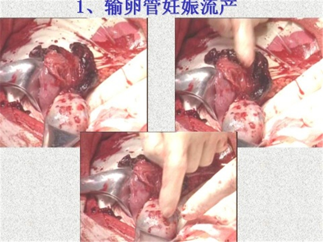 输卵管宫外孕流产图片