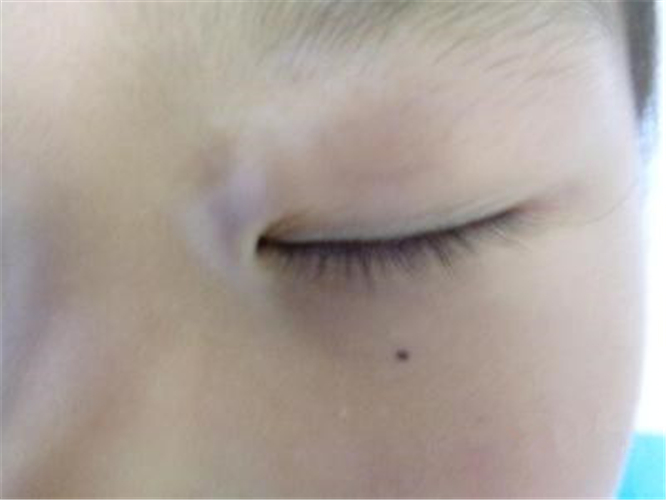 眼角白癜风早期症状图片