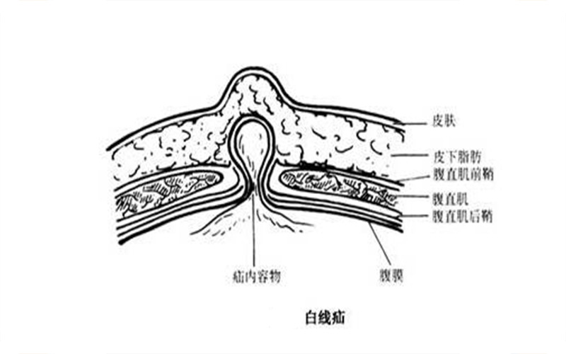 白线疝介绍_白线疝病因_白线疝治疗_白线疝医院医生