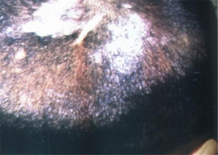 花斑癣成年背部皮肤症状图片
