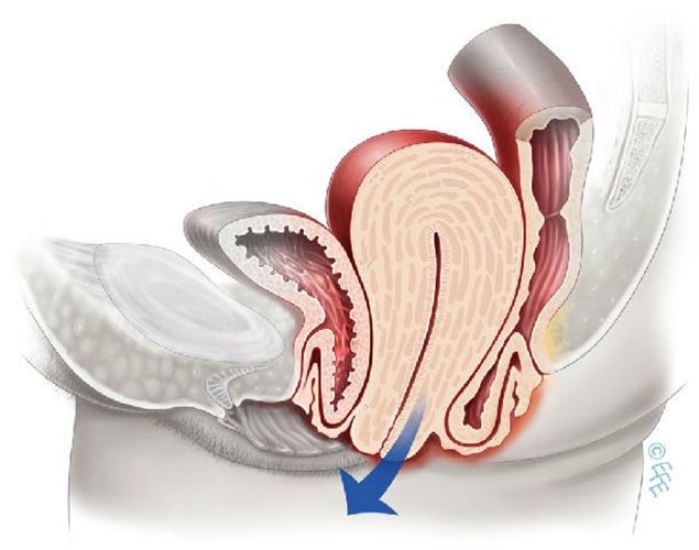 子宮脫垂陰道壁膨出了的圖片