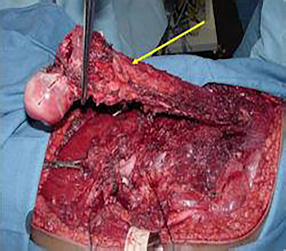 早期滑膜肉瘤症状图片
