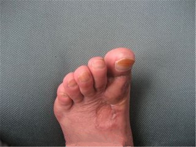 早期骨髓炎脚趾图片