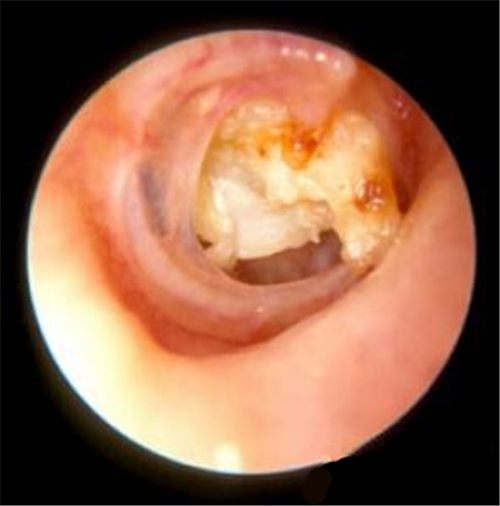 鼓膜穿孔由反復(fù)中耳炎導(dǎo)致圖片