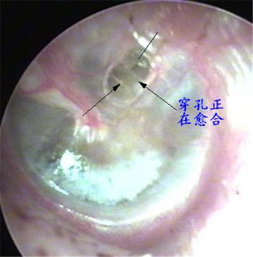 鼓膜穿孔治療后圖片