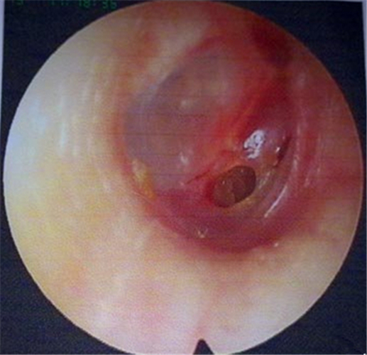 需要修補的鼓膜穿孔圖片