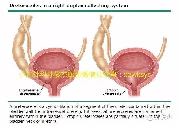 看到一个输尿管囊肿,就要考虑到它的位置,输尿管开口的位置和有没有