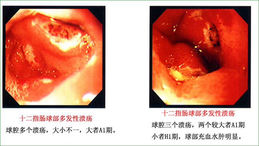 什么是十二指腸潰瘍圖片