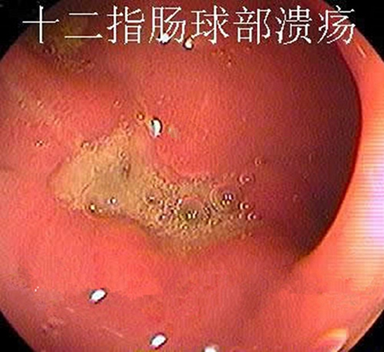 慢性十二指肠溃疡球部症状图片