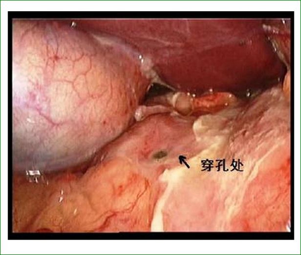 十二指腸穿孔圖片位置圖片