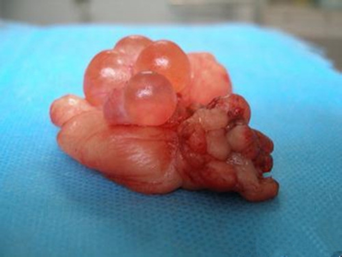 子宫肌瘤巧克力囊图片