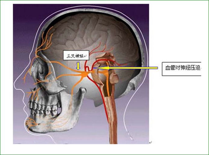 治疗三叉神经痛的方法有哪些图片