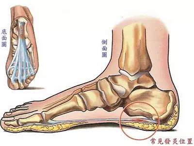 4,跖肌筋膜炎:疼痛部位位于足跟前方,勾脚,垫脚尖时疼痛加重.